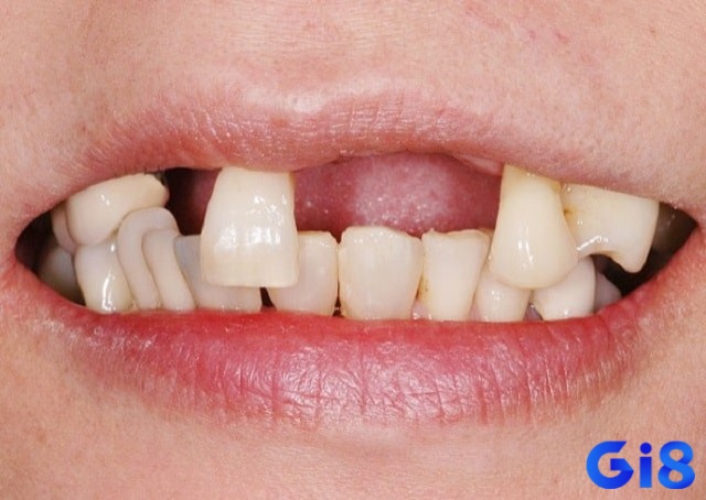 Giấc mơ thấy bị rụng nhiều răng thể hiện bạn đang gặp nhiều áp lực trong cuộc sống